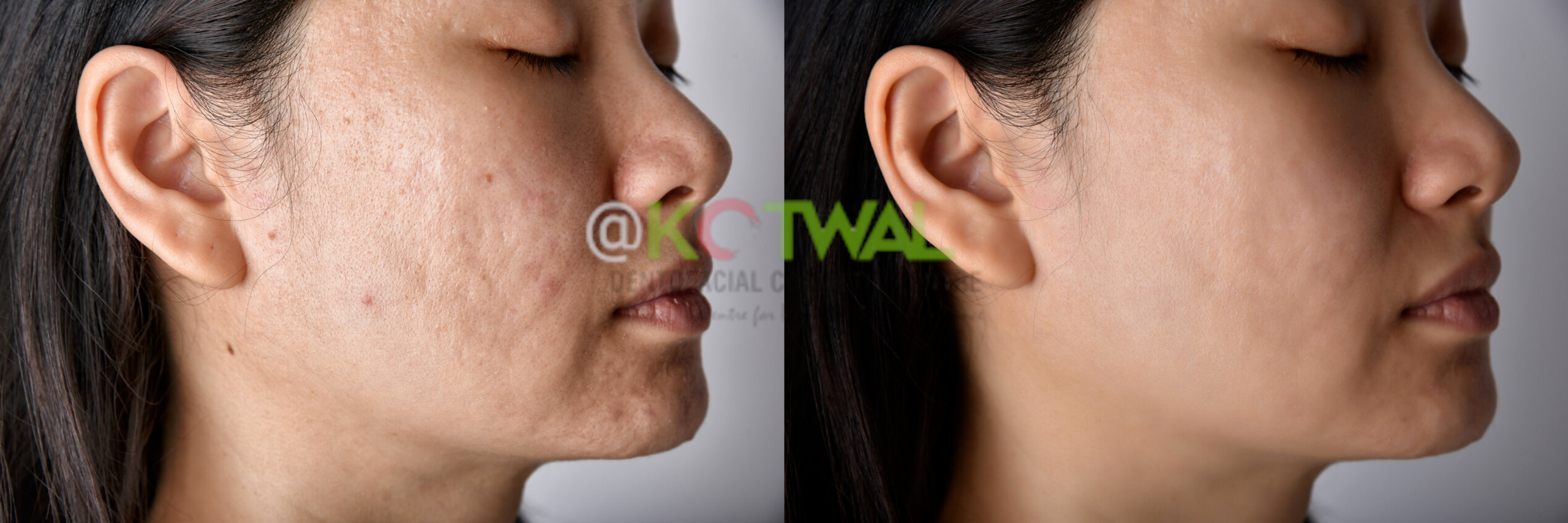Acne Scars